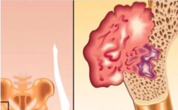 BOL U KOSTIMA, VISOK PRITISAK I TUGA Simptomi da vam u tijelu nedostaje ovaj VAŽAN VITAMIN