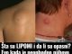 Šta su LIPOMI i da li su opasni? Evo kada je neophodno njihovo uklanjanje