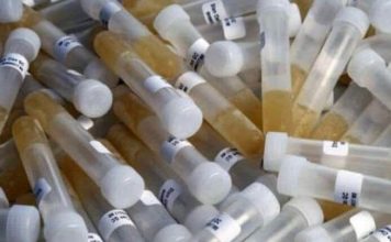 ZAŠTO IMATE JAK I NEPRIJATAN MIRIS URINA: Ovaj znak organizma ne smijete zanemariti! EVO NA ŠTA VAS UPOZORAVA