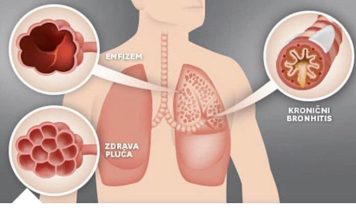 NAŠE BAKE SU NAJBOLJE ZNALE: Evo kako izliječiti astmu, bronhitis i plućne bolesti