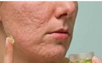 Evo kako da napravite domaću kremu za 10 sekundi koja uklanja ožiljake i podmlađuje kožu lica