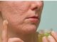 Evo kako da napravite domaću kremu za 10 sekundi koja uklanja ožiljake i podmlađuje kožu lica