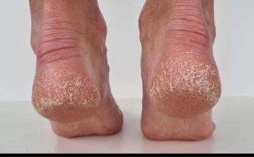 Jeftino čudo iz kuhinje koje spašava vaša stopala: Kao rukom rješava ispucale peta, gljivice i kurje oči