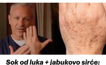 SOK OD LUKA + JABUKOVO SIRĆE: Samo POMIJEŠAJTE i riješite se staračkih pjega na rukama, licu i dekolteu JEDNOM za svagda