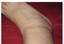 KAD SKINETE ČARAPE OSTANU VAM TRAGOVI NA NOGAMA: Evo šta se dešava sa vašim zdravljem