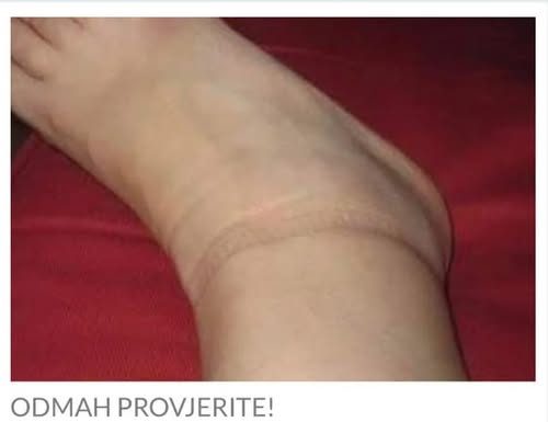 KAD SKINETE ČARAPE OSTANU VAM TRAGOVI NA NOGAMA: Evo šta se dešava sa vašim zdravljem