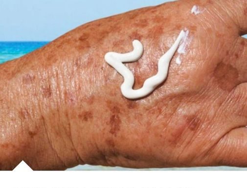 PRIMJETILI STE DA VAM SE POJAVLJUJU STARAČKE PJEGE : To je znak da imate ozbiljan problem sa jednim organom!