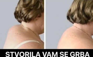 STVORILA VAM SE GRBA NA VRATU, EVO KAKO ĆETE JE ISPRAVITI: Trebate samo slediti Ovih 5 saveta!