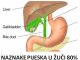 NAZNAKE PIJESKA U ŽUČI 80% LJUDI NE ZNA PREPOZNATI. Obratite pažnju na simptome!
