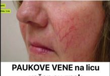 Prisutnost paučastih vena na licu služi kao ključni pokazatelj, signalizirajući mogućnost nadolazeće bolesti.