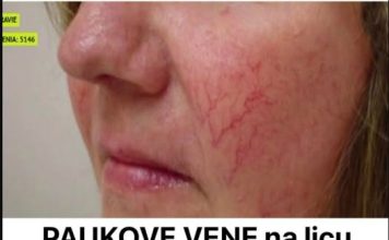 Prisutnost paučastih vena na licu služi kao ključni pokazatelj, signalizirajući mogućnost nadolazeće bolesti.