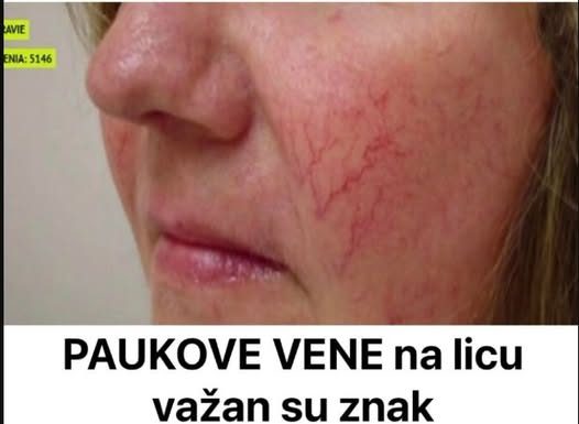 Prisutnost paučastih vena na licu služi kao ključni pokazatelj, signalizirajući mogućnost nadolazeće bolesti.