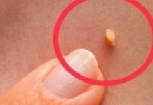 NADALEKO PRIZNATI NARODNI LIJEK ZA LIJEČENJE BRADAVICA JE NITKO DRUGI DO TRAVA RUSA