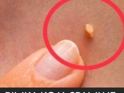 NADALEKO PRIZNATI NARODNI LIJEK ZA LIJEČENJE BRADAVICA JE NITKO DRUGI DO TRAVA RUSA