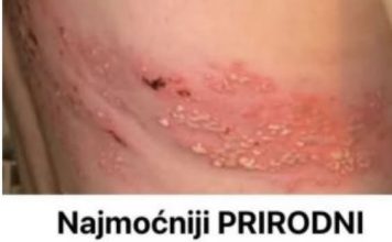 Najmoćniji PRIRODNI LIJEK za HERPES ZOSTER: uklonite ga zauvijek!