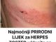 Najmoćniji PRIRODNI LIJEK za HERPES ZOSTER: uklonite ga zauvijek!