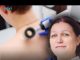 Najčešći karcinom na svijetu pogađa svaku petu osobu: Dermatolog savjetuje kako da ga prepoznate