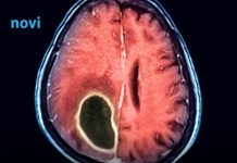 Ovo je sedam simptoma koji mogu otkriti tumor na mozgu