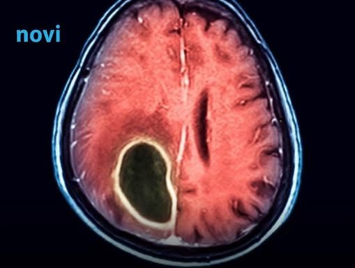 Ovo je sedam simptoma koji mogu otkriti tumor na mozgu