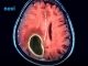 Ovo je sedam simptoma koji mogu otkriti tumor na mozgu