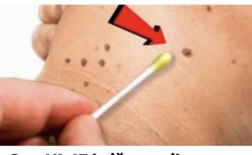 OVO ULJE briše papilome, bradavice, pa čak i gljivice – svaka kap je NEPROCJENJIVA!