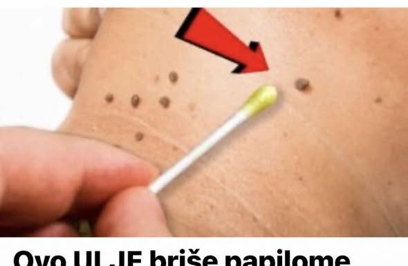 OVO ULJE briše papilome, bradavice, pa čak i gljivice – svaka kap je NEPROCJENJIVA!
