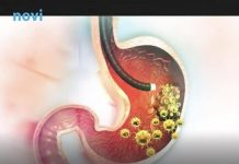 5 ranih simptoma raka želuca: Tumor može da raste godinama, a svi pacijenti prvo osjete ovo