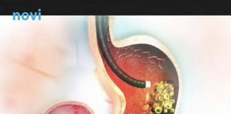 5 ranih simptoma raka želuca: Tumor može da raste godinama, a svi pacijenti prvo osjete ovo