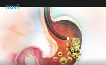 5 ranih simptoma raka želuca: Tumor može da raste godinama, a svi pacijenti prvo osjete ovo