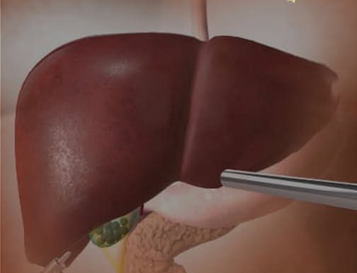 OVA HRANA UNIŠTAVA JETRU SKORO ISTO KOLIKO I ALKOHOL: 5 namirnica čiji unos morate ograničiti