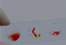 Liječnici otkrili koja krvna grupa ima najmanji rizik od raka