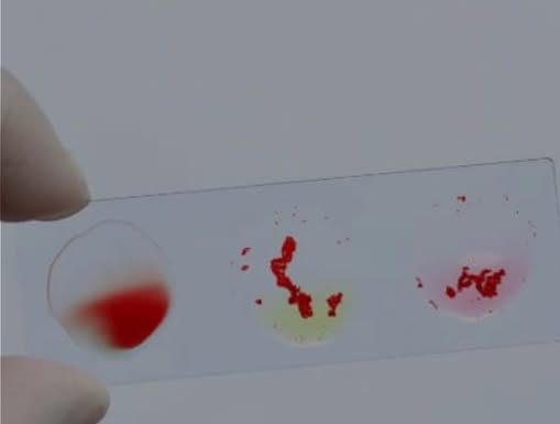 Liječnici otkrili koja krvna grupa ima najmanji rizik od raka