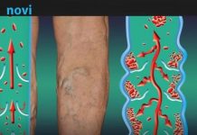 Najraniji signali da se u tijelu formirao tromb: Ove simptome nije pametno ignorisati