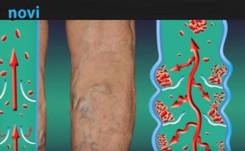 Najraniji signali da se u tijelu formirao tromb: Ove simptome nije pametno ignorisati