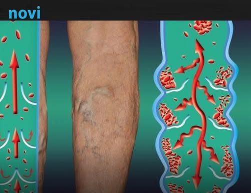 Najraniji signali da se u tijelu formirao tromb: Ove simptome nije pametno ignorisati