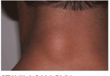 ZA MANJE OD 10 DANA: Riješite se masnog tkiva bez hiruškog odstranjivanja!