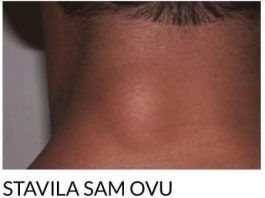 ZA MANJE OD 10 DANA: Riješite se masnog tkiva bez hiruškog odstranjivanja!