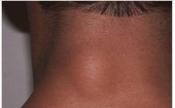 ZA MANJE OD 10 DANA: Riješite se masnog tkiva bez hiruškog odstranjivanja!