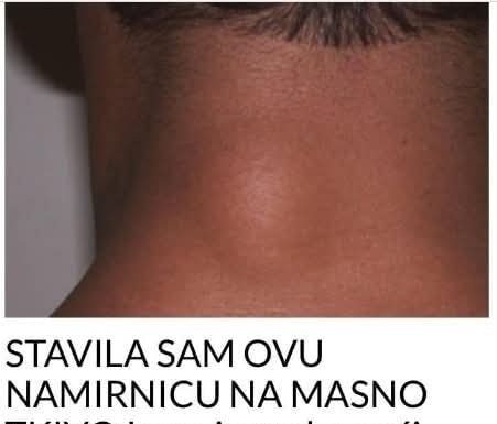 ZA MANJE OD 10 DANA: Riješite se masnog tkiva bez hiruškog odstranjivanja!