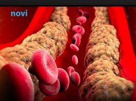 Holesterol ne skače od mesa, već od ove 2 stvari koje su smrt za jetru i samo gomilaju masnoću
