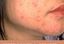 OPREZ! RODITELJI, OBRATITE PAŽNJU NA OVO! Ove navike mogu spasiti kožu vaše djece od akni, VAŽNO JE DA POČNETE ODMAH