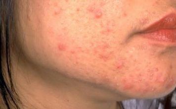 OPREZ! RODITELJI, OBRATITE PAŽNJU NA OVO! Ove navike mogu spasiti kožu vaše djece od akni, VAŽNO JE DA POČNETE ODMAH