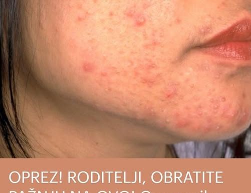 OPREZ! RODITELJI, OBRATITE PAŽNJU NA OVO! Ove navike mogu spasiti kožu vaše djece od akni, VAŽNO JE DA POČNETE ODMAH