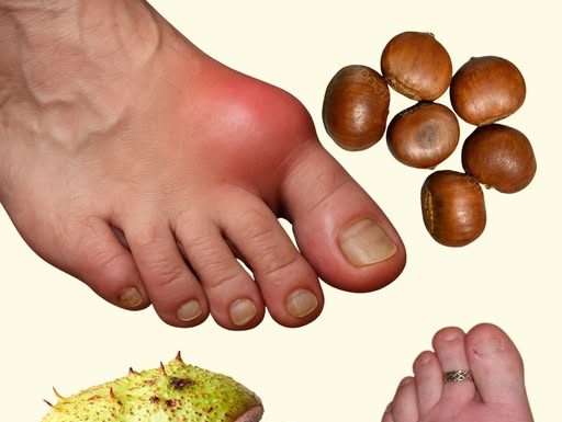 DIVLJI KESTEN – moćan lijek za otečene noge i bolju cirkulaciju