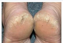 TREBA VAM SAMO ASPIRIN I JEDNA NAMIRNICA IZ KUHINJE: Ispucala KOŽA sa peta nestaje za čas