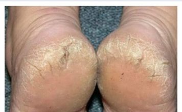 TREBA VAM SAMO ASPIRIN I JEDNA NAMIRNICA IZ KUHINJE: Ispucala KOŽA sa peta nestaje za čas