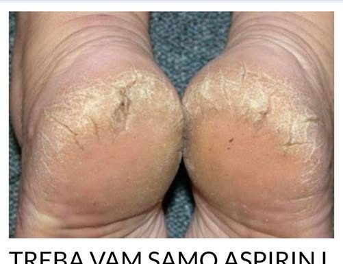 TREBA VAM SAMO ASPIRIN I JEDNA NAMIRNICA IZ KUHINJE: Ispucala KOŽA sa peta nestaje za čas