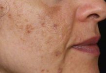 Evo kako da sa ovim jednostavnim trikom od 2 sastojka izbrišete mrlje s kože!