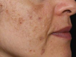 Evo kako da sa ovim jednostavnim trikom od 2 sastojka izbrišete mrlje s kože!