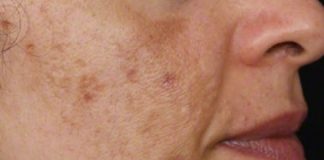 Evo kako da sa ovim jednostavnim trikom od 2 sastojka izbrišete mrlje s kože!